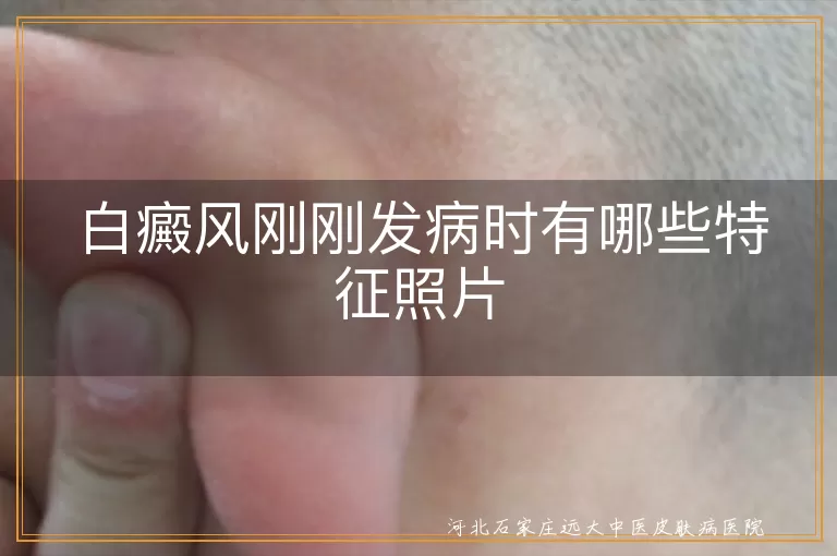 白癜风早期症状照,白斑初发典型图,白癜风刚长什么样