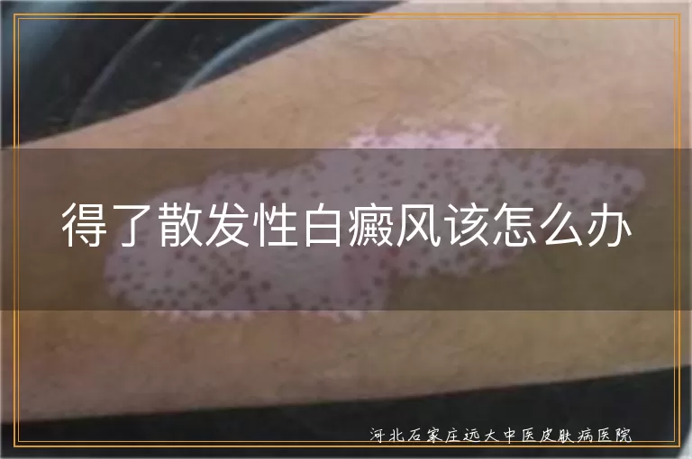 散发性白癜风如何应对,白斑患者日常调理指南,白癜风心理与免疫管理