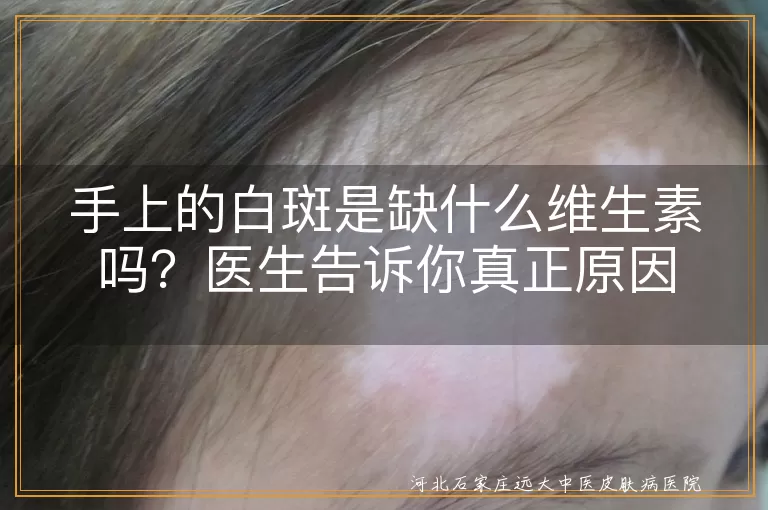 手背白斑是不是缺维生素,白癜风病因不只是缺维生素,白斑出现背后缺乏啥