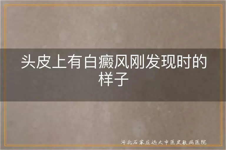 头皮早期白癜风表现,白斑初现头皮特征,刚发现头皮白癜风症状