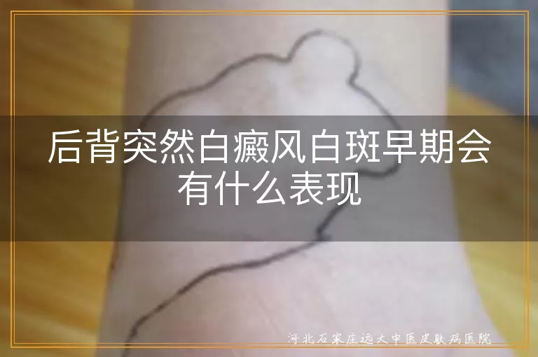 后背白癜风早期表现,后背白斑初期症状,白癜风白斑突然出现