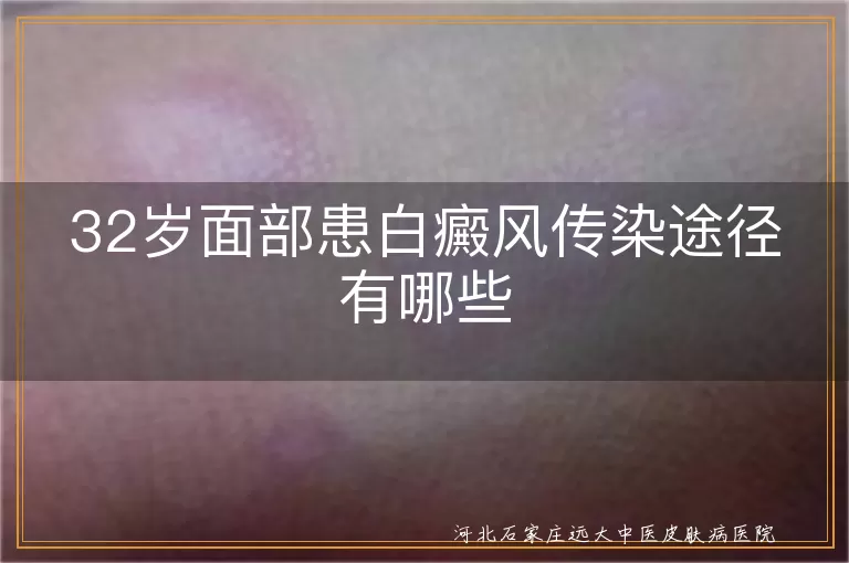 面部白斑是否传染真相,白癜风日常接触风险,白斑误区大揭秘