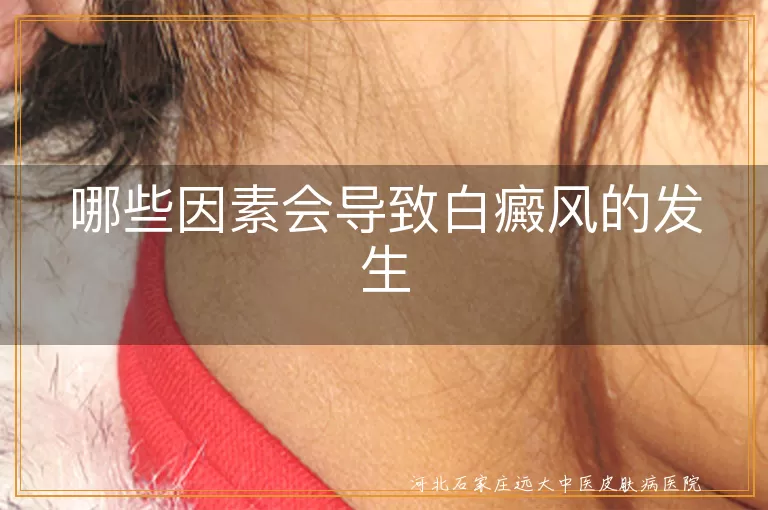 白癜风诱因有哪些,白斑为何突然出现,白癜风与免疫关系