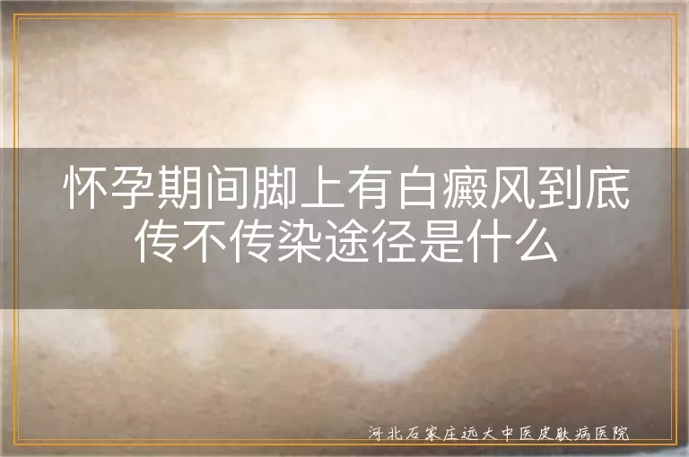 怀孕期间脚上有白癜风到底传不传染途径是什么