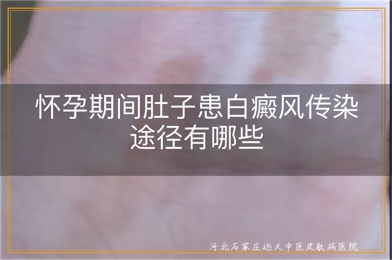 怀孕期间肚子患白癜风传染途径有哪些