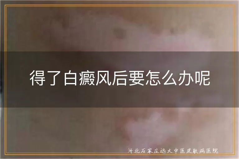 得了白癜风后要怎么办呢