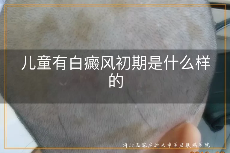 儿童有白癜风初期是什么样的
