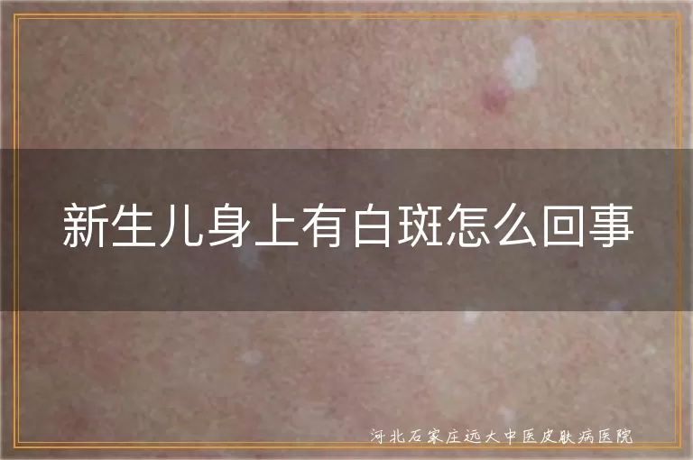 新生儿白斑是不是白癜风,宝宝皮肤白斑要警惕白癜风,婴儿白癜风白斑早期症状