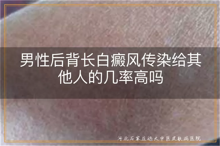 白癜风背部会传染给身边人吗,男性后背白斑扩散风险高不高,后背白癜风会不会通过接触传染