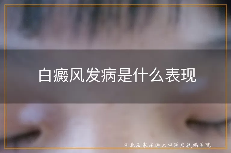 白癜风早期表现有哪些,白斑扩散速度有多快,白癜风典型症状图片