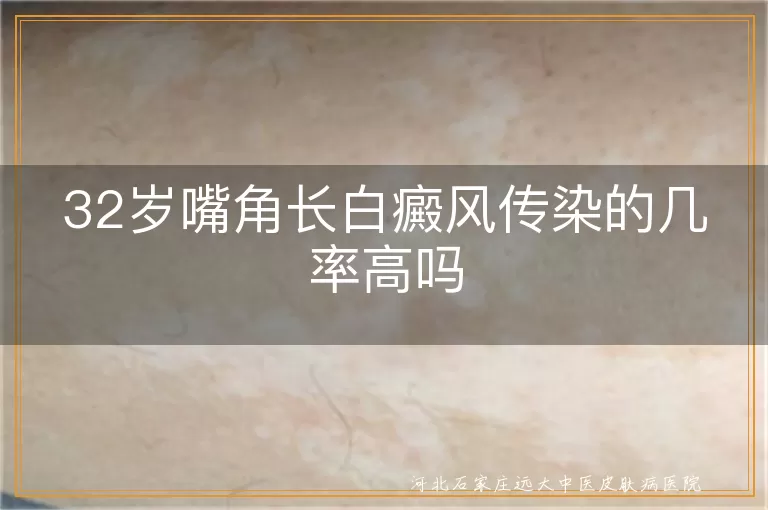 嘴角白斑会不会传给别人,白癜风在嘴角会扩散吗,32岁嘴角白癜风传染概率