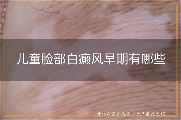 儿童脸部白癜风早期有哪些