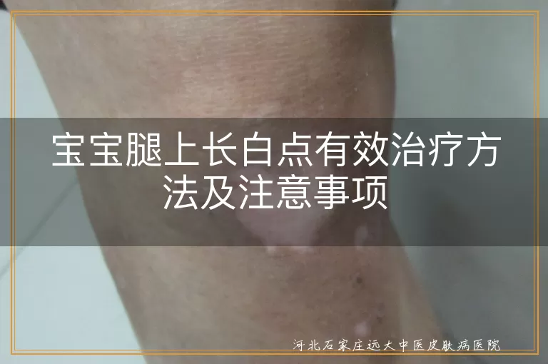 宝宝腿上长白点有效治疗方法及注意事项