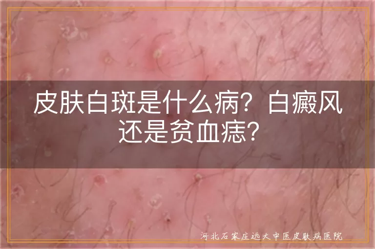 白癜风与白斑如何区分,白斑是白癜风还是贫血痣,皮肤白斑和白癜风的区别