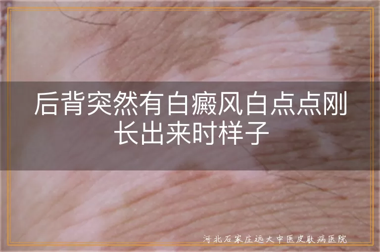 后背白癜风初期白点点图,白癜风初发小斑疹样子,早期白斑扩散前变化