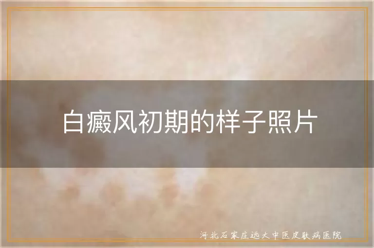 白癜风早期白斑模样照片,白斑初期图片展示,白癜风刚开始照片参考