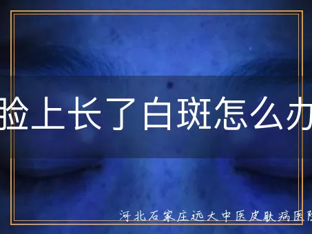 脸上白癜风早期怎么判断,面部白斑扩散了怎么办,脸上白癜风会自愈吗