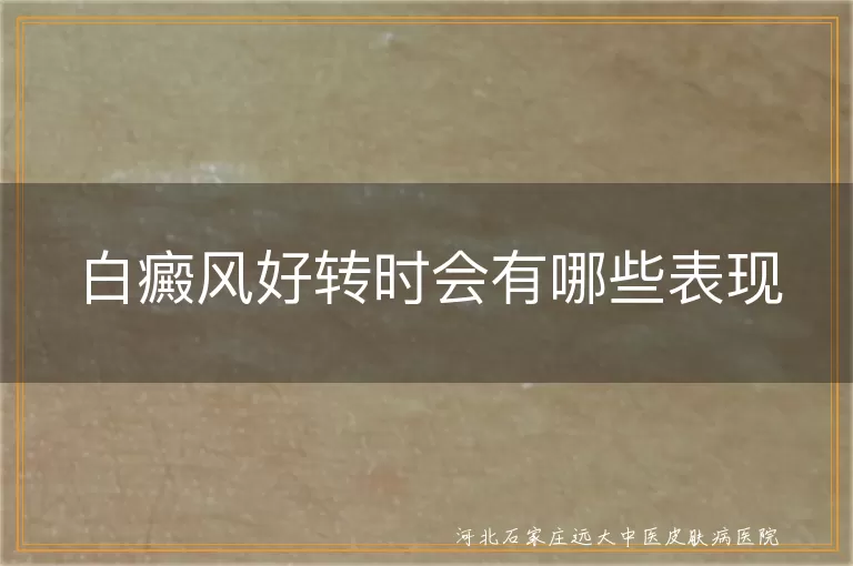 白斑颜色变淡的白癜风迹象,白癜风边缘色素带向内推进,白斑处出现针尖样毛囊色素岛