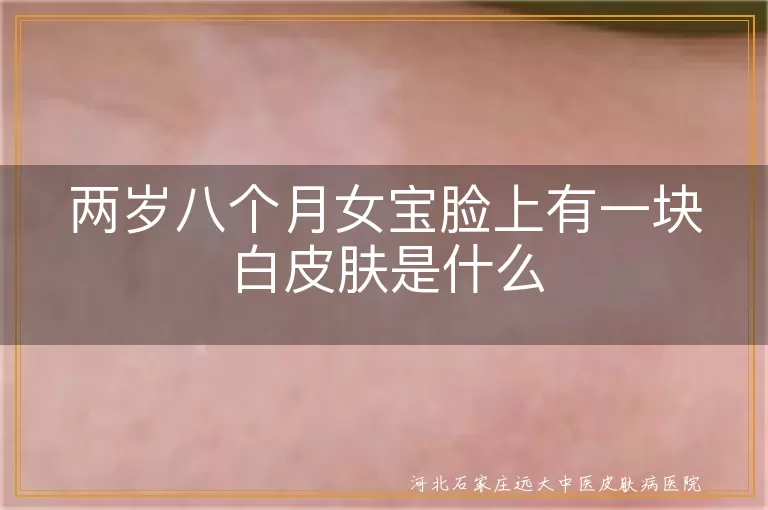 两岁八个月女宝脸上有一块白皮肤是什么
