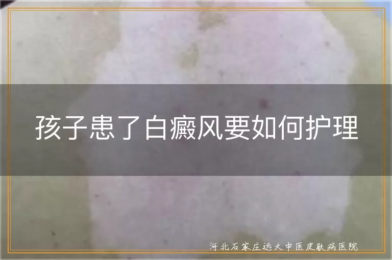 孩子患了白癜风要如何护理