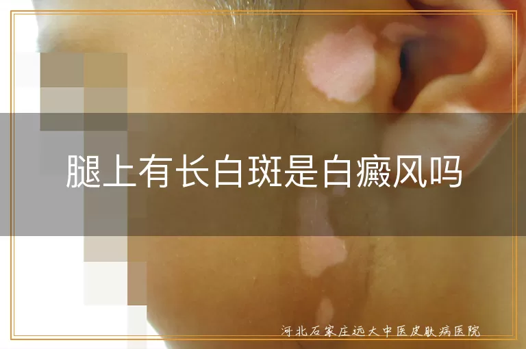 腿上白斑是不是白癜风,腿部白癜风早期症状识别,白癜风白斑和汗斑怎么区分