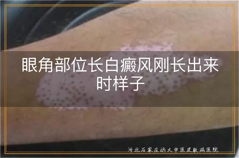眼角初期白癜风症状,眼角白斑早期表现,白癜风眼角刚长样子