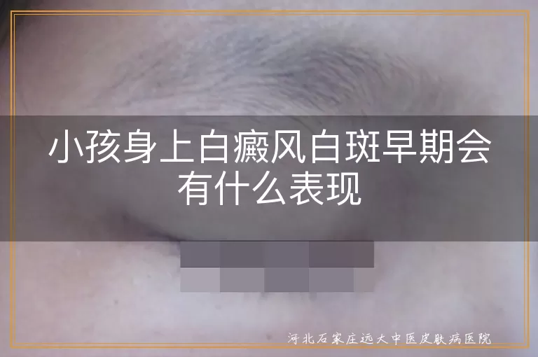 儿童早期白斑表现有哪些,小孩白癜风初期症状图,宝宝白斑和白癜风区别