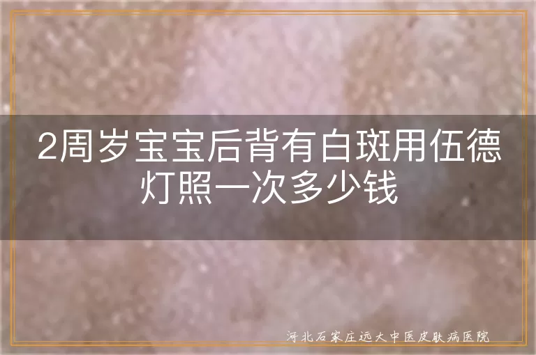 宝宝后背白斑照灯费用,婴幼儿白癜风伍德灯检查,白斑儿童伍德灯价格