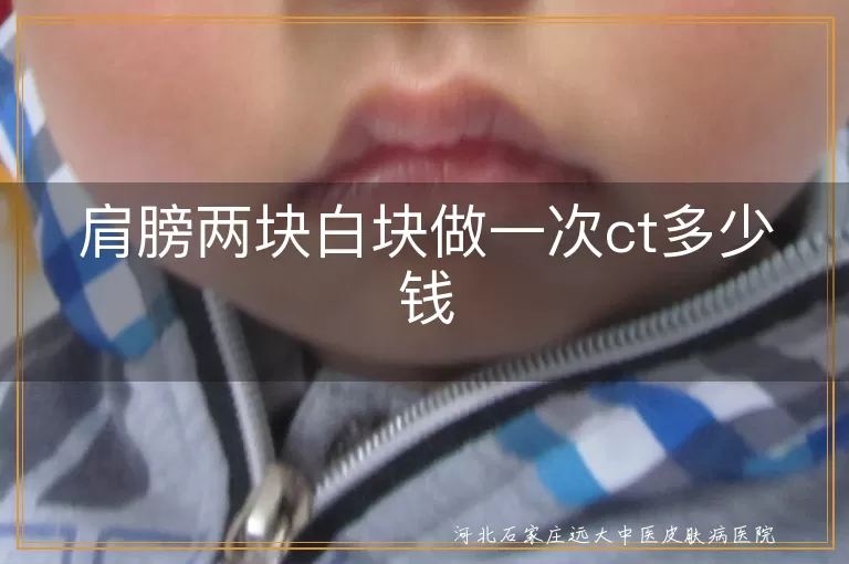 肩膀白斑ct检查费用,白癜风ct价格参考,肩部白斑影像检查多少钱