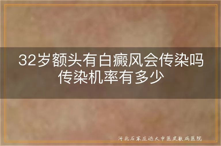 额头白癜风白斑会不会传染,32岁白癜风白斑传染几率,白癜风白斑日常接触会传播吗