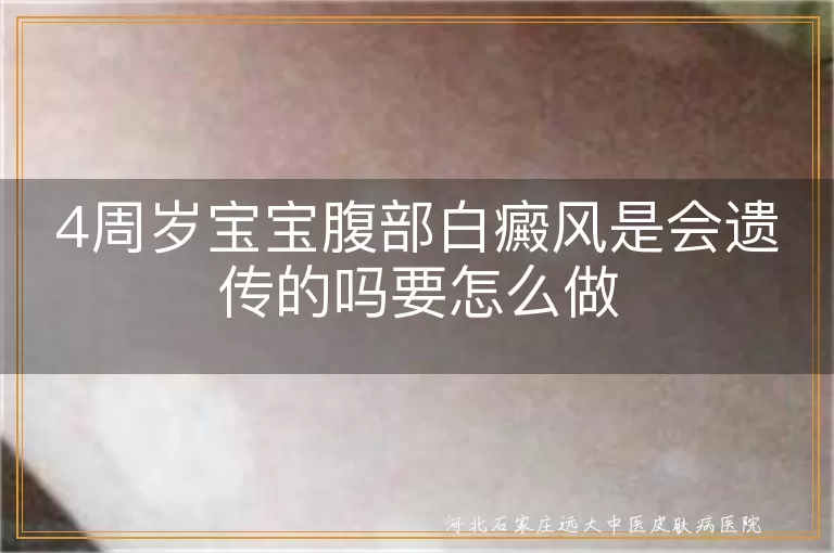 宝宝腹部白斑会遗传吗,4岁白癜风怎么办,儿童白斑遗传风险