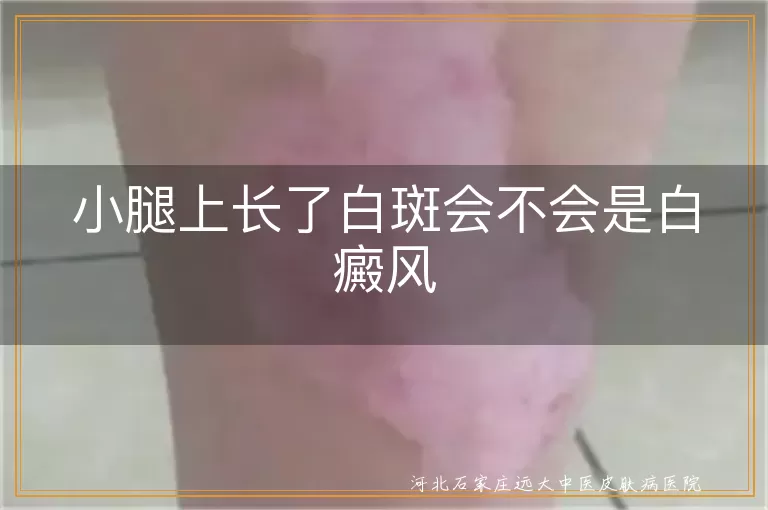 小腿上长了白斑会不会是白癜风