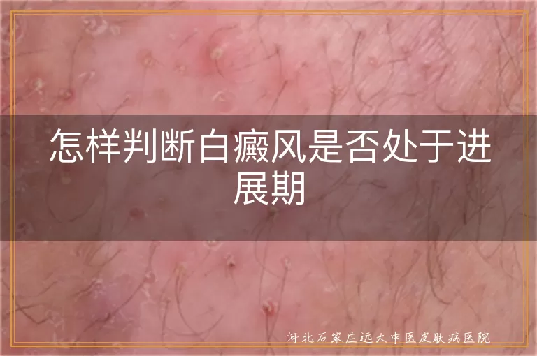 怎样判断白癜风是否处于进展期