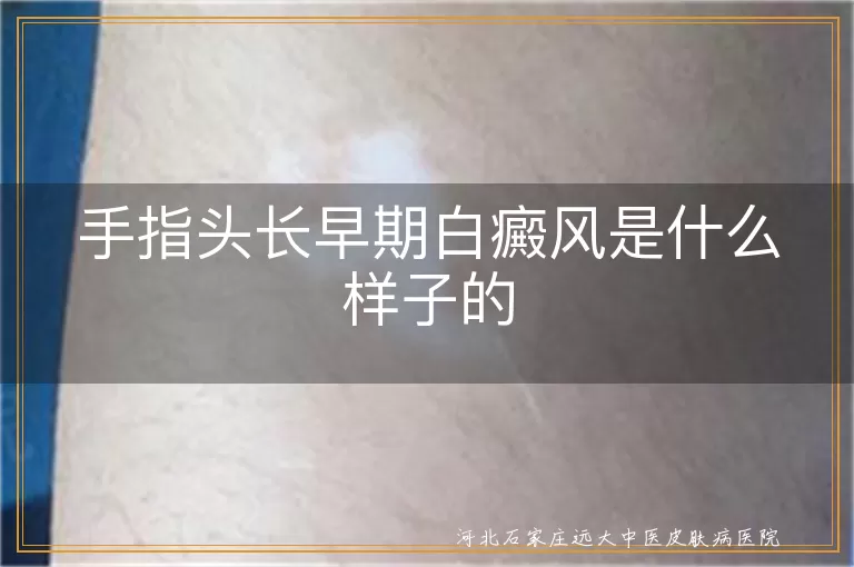 手指头长早期白癜风是什么样子的