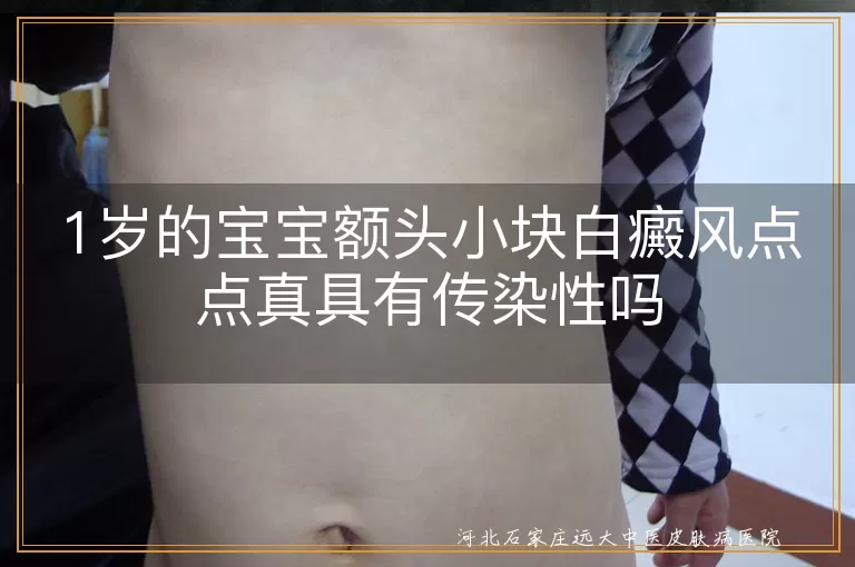 1岁的宝宝额头小块白癜风点点真具有传染性吗