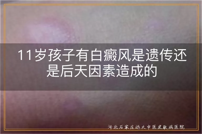11岁孩子有白癜风是遗传还是后天因素造成的