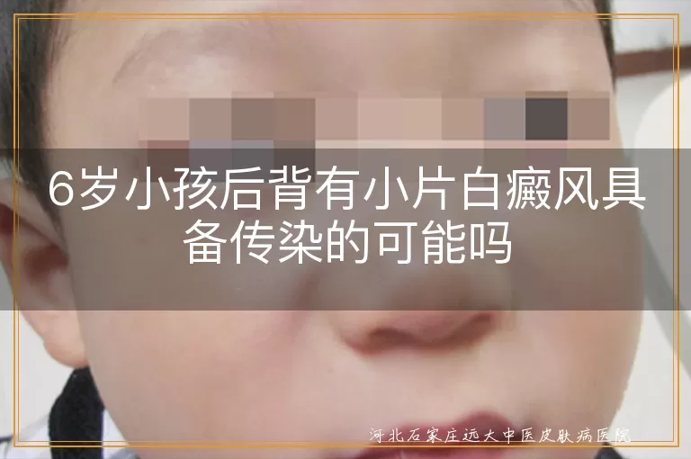 6岁小孩后背有小片白癜风具备传染的可能吗