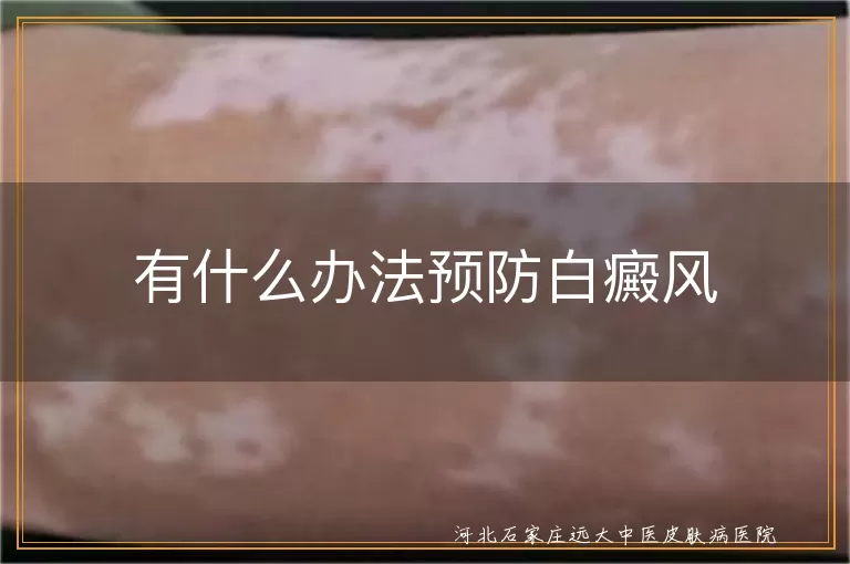 有什么办法预防白癜风