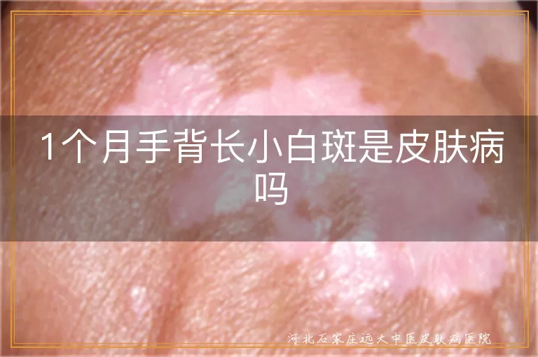 1个月手背长小白斑是皮肤病吗