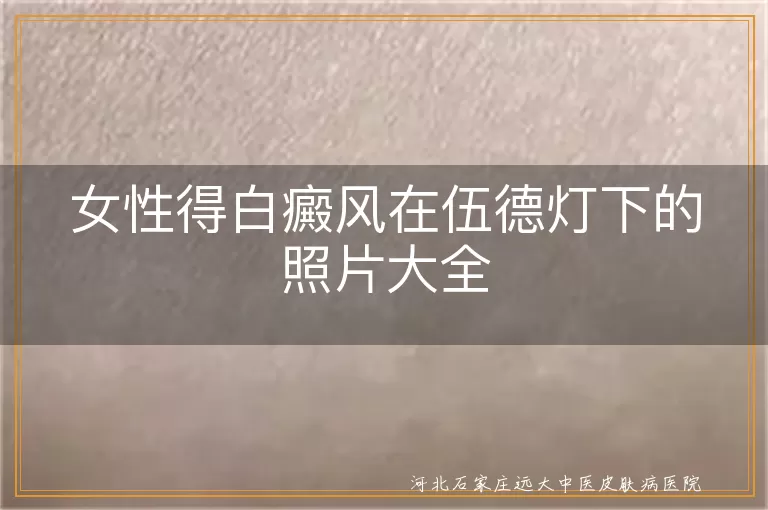 女性得白癜风在伍德灯下的照片大全