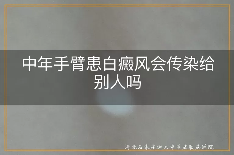 中年手臂患白癜风会传染给别人吗
