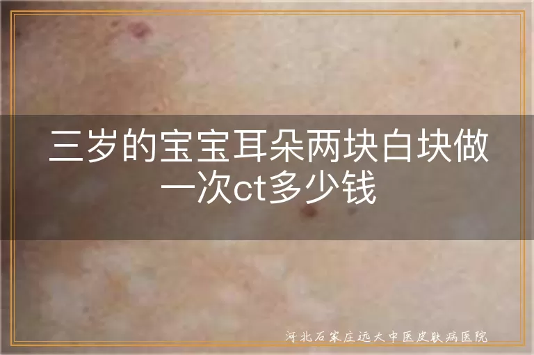 三岁的宝宝耳朵两块白块做一次ct多少钱