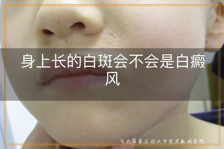身上长的白斑会不会是白癜风