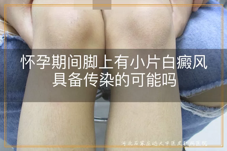 孕期脚部白斑会传染吗,孕妇白癜风传染风险,白癜风白斑有无传染力