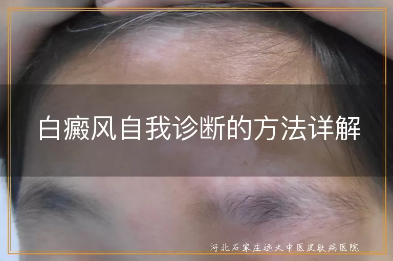 白癜风自我诊断的方法详解