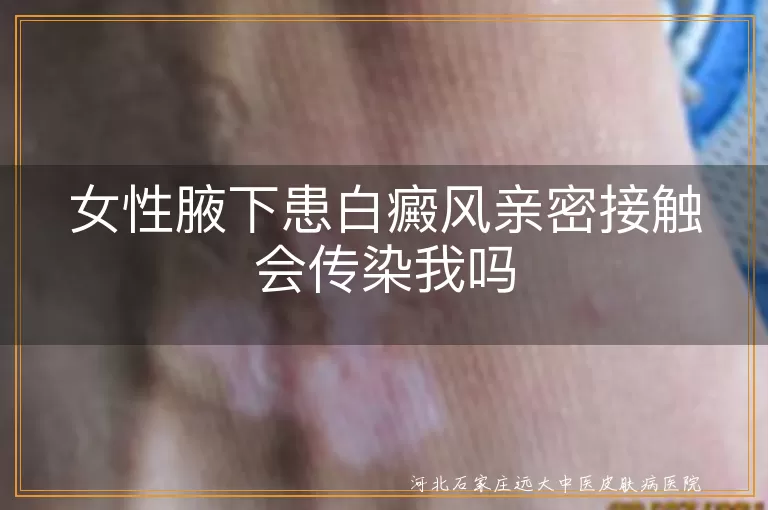女性腋下患白癜风亲密接触会传染我吗