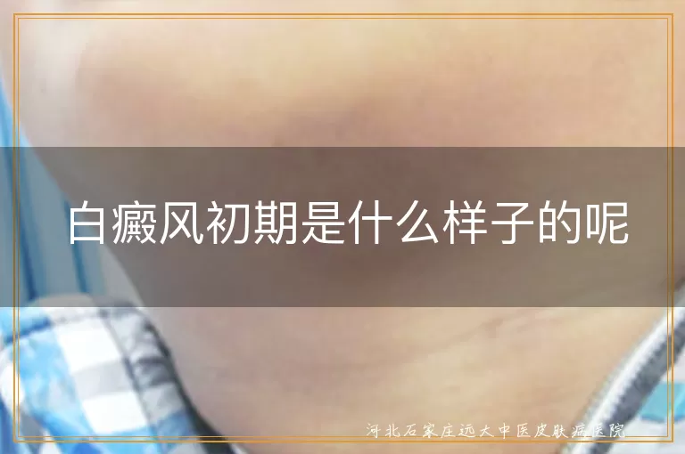 白癜风初期是什么样子的呢