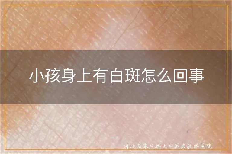 小孩身上白癜风斑块咋回事,儿童白斑是白癜风吗,孩子身上出现白斑是什么皮肤问题