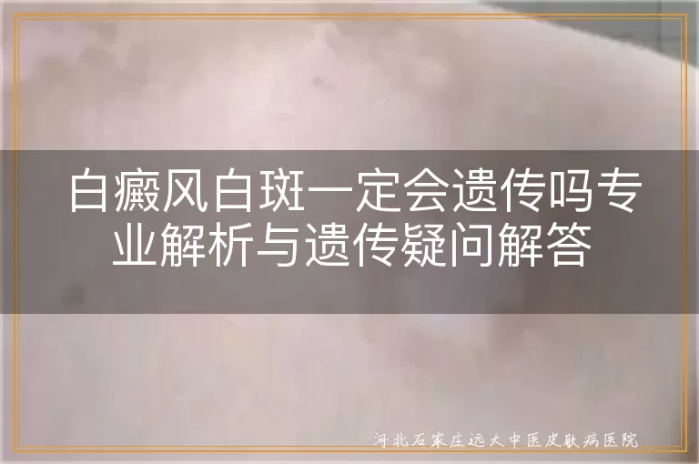 白癜风遗传风险有多高,白斑家族史会不会传给孩子,白癜风隔代遗传概率大吗