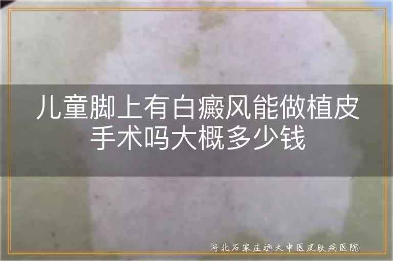 儿童脚部白斑能否植皮,儿童白癜风植皮多少钱,孩子脚上白癜风手术费用